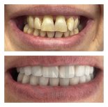 Before and after dental veneers at Nifa Dent International, smile makeover visible result
