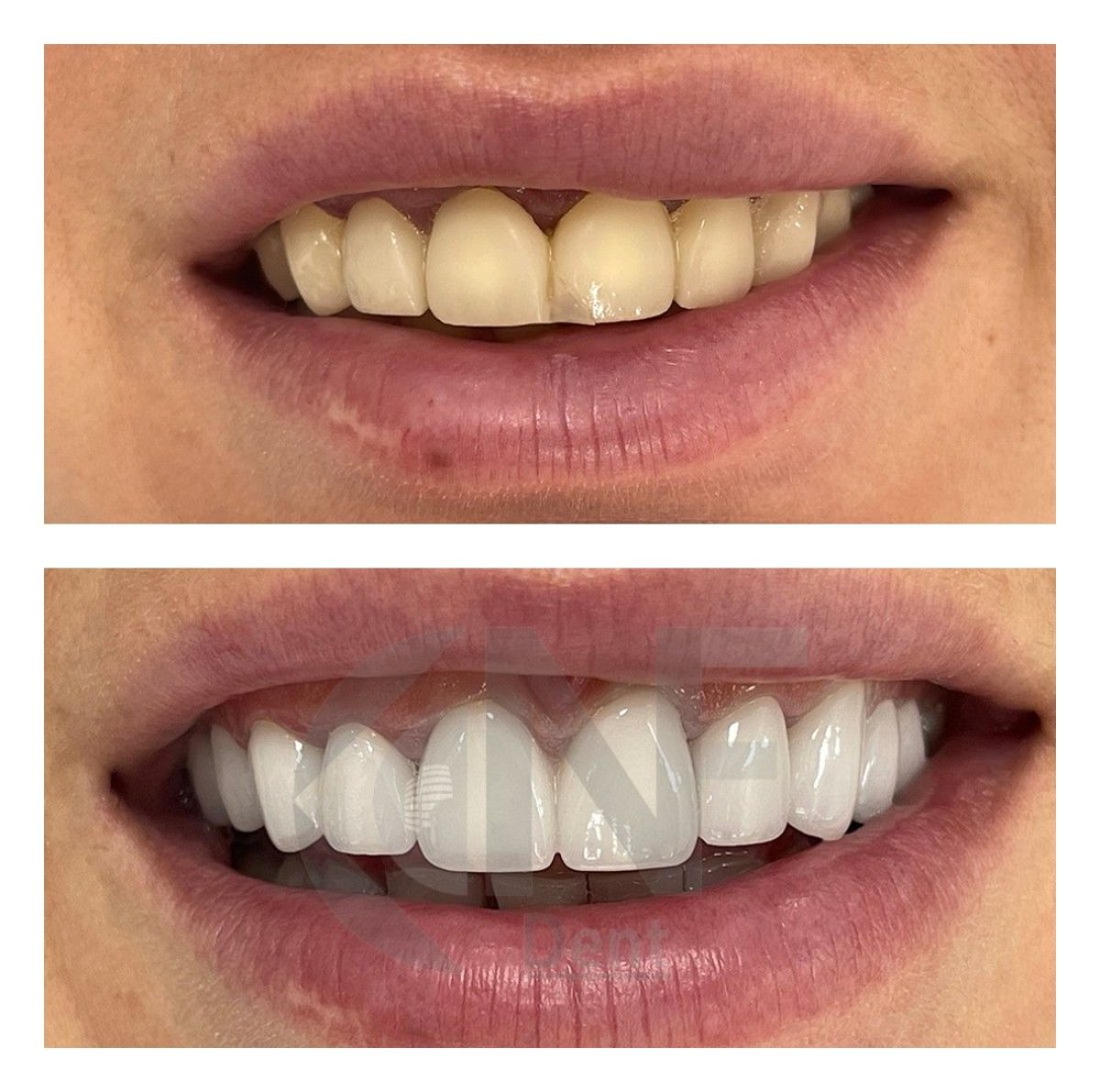 قبل وبعد عدسات الأسنان في Nifa Dent International، نتيجة تجميل الابتسامة