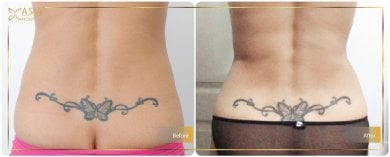 Before and after liposuction result at Asia Cosmetic Hospital, visible waist contour improvement