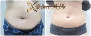 Before and after liposuction results at Asia Cosmetic Hospital, visible abdominal contouring
