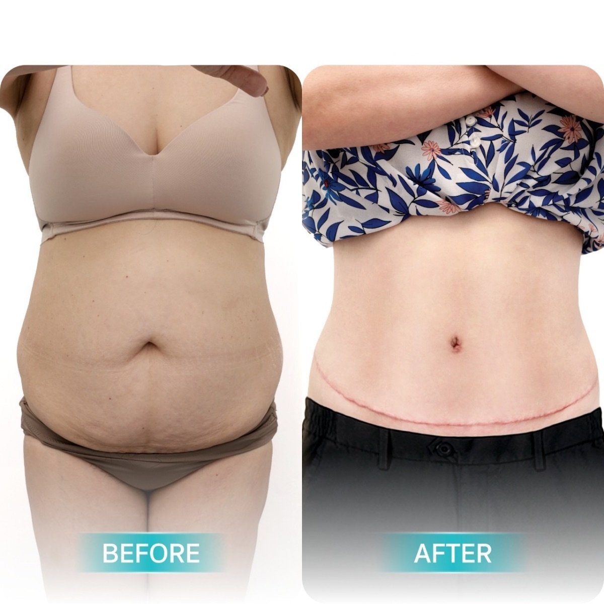 Antes y después de mommy makeover en Wansiri Hospital: resultados visibles en el abdomen