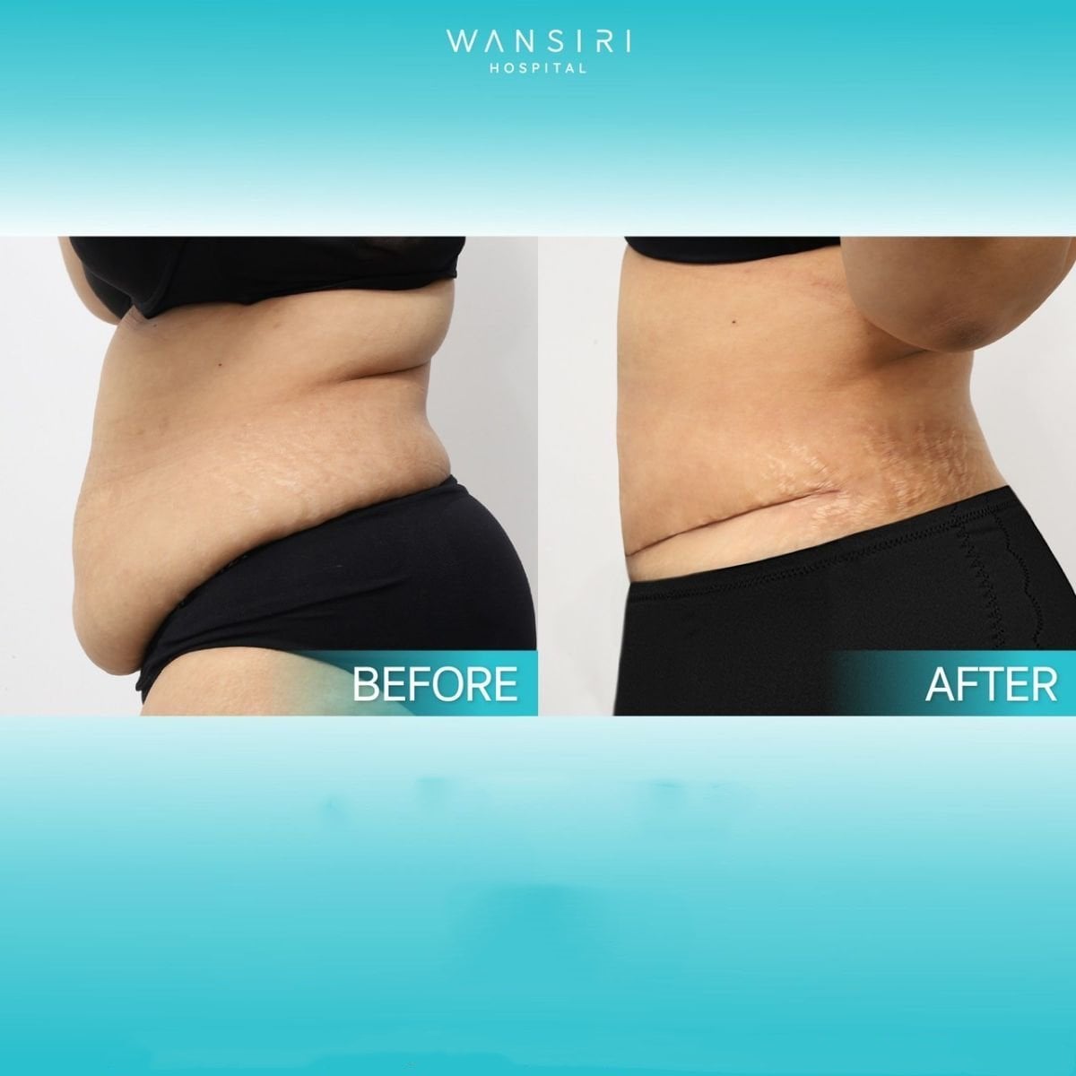 Resultados antes y después de mommy makeover en Wansiri Hospital – contorno abdominal visible