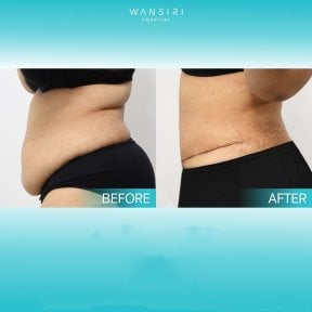 Mommy makeover before and after results at Wansiri Hospital – visible abdominal contouring