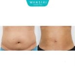 Mommy makeover before and after results at Wansiri Hospital – visible abdominal contouring