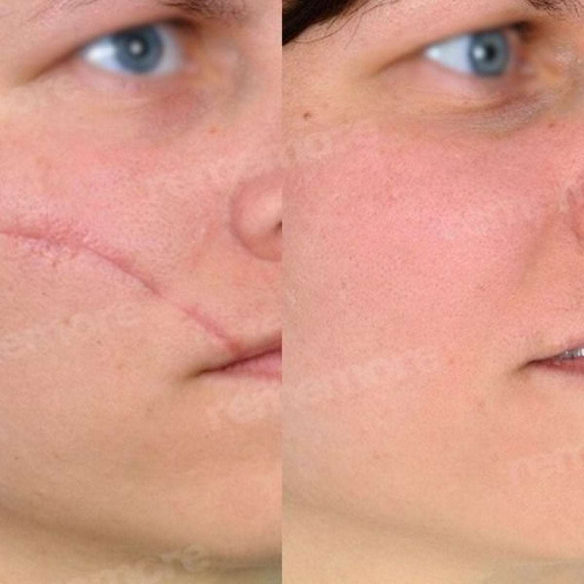 Resultados antes y después de la revisión de cicatrices faciales en Memorial Şişli Hospital