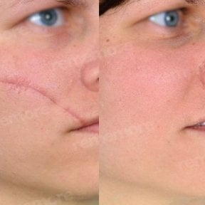 Before and after scar revision results on face at Memorial Şişli Hospital, improved skin appearance