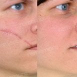 Before and after scar revision results on face at Memorial Şişli Hospital, improved skin appearance