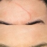 Before and after scar revision results on forehead at Memorial Şişli Hospital, smoother skin