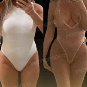 Before and after liposuction results at Memorial Bahçelievler Hospital, improved body contour