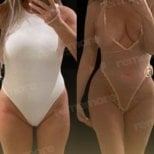 Before and after liposuction results at Memorial Bahçelievler Hospital, improved body contour