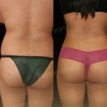 Before and after liposuction results at Memorial Bahçelievler Hospital, improved waist contour