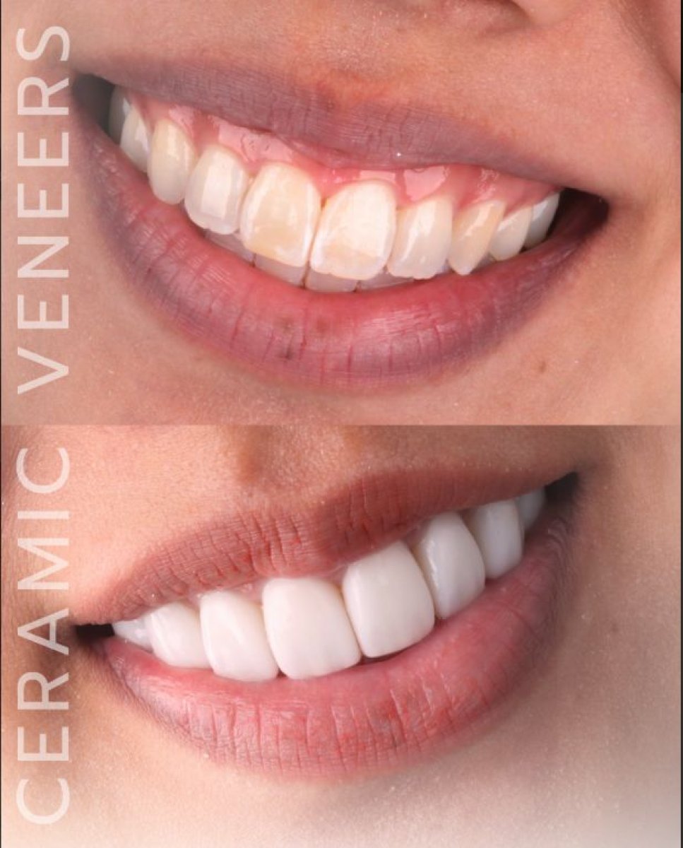 Resultado antes y después de carillas cerámicas en SmileBox Dental Clinic - Thonglor, Sukhumvit Branch
