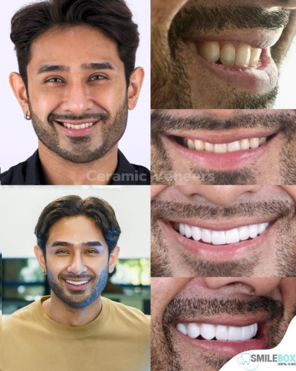Resultado antes y después de carillas en SmileBox Dental Clinic - Thonglor, Sukhumvit Branch