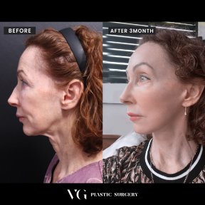 Vorher-nachher-Ergebnis endoskopisches Facelifting bei VG Plastic Surgery, sichtbare Verjüngung