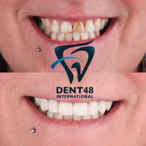 Smile makeover before and after results at Dent48 Oral and Dental Health Polyclinics