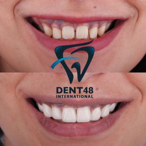 Smile makeover before and after results at Dent48 Oral and Dental Health Polyclinics