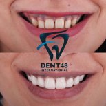 Smile makeover before and after results at Dent48 Oral and Dental Health Polyclinics