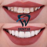 Smile makeover before and after results at Dent48 Oral and Dental Health Polyclinics, veneers