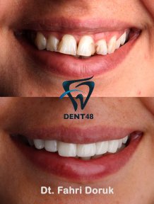 Smile makeover before and after results at Dent48 Oral and Dental Health Polyclinics