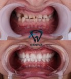 Результати до і після зміни посмішки в Dent48 Oral and Dental Health Polyclinics