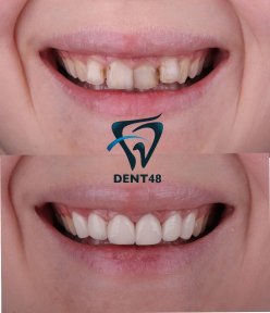 Smile makeover before and after results at Dent48 Oral and Dental Health Polyclinics