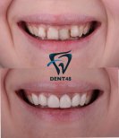 Smile makeover before and after results at Dent48 Oral and Dental Health Polyclinics
