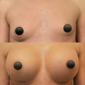 Vorher-nachher-Ergebnis Brustvergrößerung bei Dr. Safa Manav Clinic, mehr Volumen