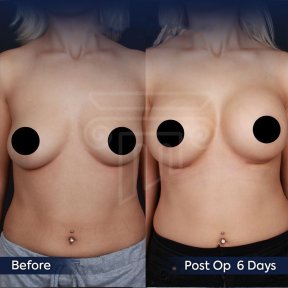 Vorher-nachher-Ergebnis Brustvergrößerung bei Dr. Safa Manav Clinic, 6 Tage postoperativ