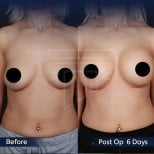 Vorher-nachher-Ergebnis Brustvergrößerung bei Dr. Safa Manav Clinic, 6 Tage postoperativ
