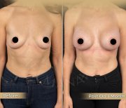 Vorher-nachher-Ergebnis Brustvergrößerung bei Dr. Safa Manav Clinic, 3 Monate postoperativ