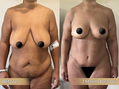 Vorher-nachher Brustvergrößerung mit Fetttransfer bei Dr. Safa Manav, 7 Monate Ergebnis