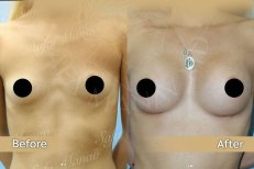 Vorher-nachher-Ergebnis Brustvergrößerung mit Eigenfett in der Dr. Safa Manav Klinik