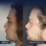 Vorher-nachher-Ergebnis der Nasenkorrektur in der Dr. Safa Manav Clinic, verbesserte Nasenform