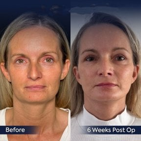 Before and after neck lift results at Dr. Safa Manav Clinic, visible jawline and neck contour
