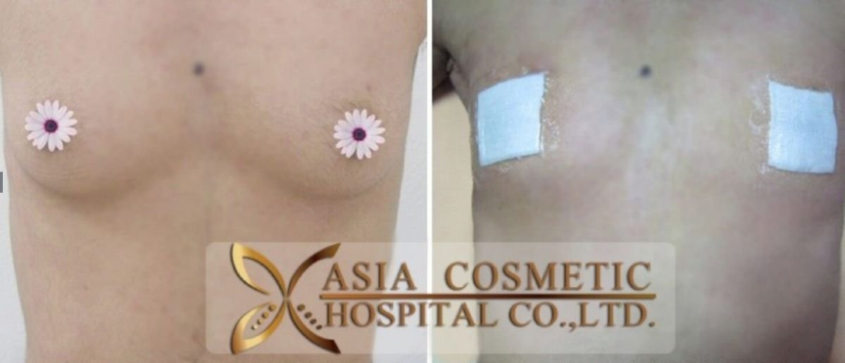 Результати до і після операції гінекомастії в Asia Cosmetic Hospital, корекція грудей