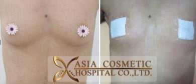 Before and after gynecomastia surgery results at Asia Cosmetic Hospital, male chest contouring