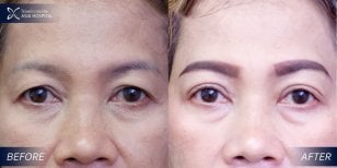 Before and after upper and lower eyelid surgery results at Asia Cosmetic Hospital, rejuvenated eyes