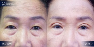 Before and after upper and lower eyelid surgery results at Asia Cosmetic Hospital, eye rejuvenation