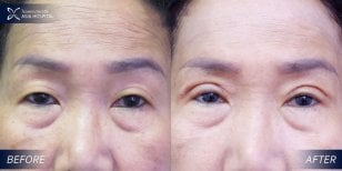 Before and after upper and lower eyelid surgery results at Asia Cosmetic Hospital, eye rejuvenation