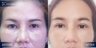 Upper and lower eyelid surgery before and after results at Asia Cosmetic Hospital, rejuvenated look