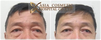 Before and after upper and lower eyelid surgery results at Asia Cosmetic Hospital, rejuvenated look