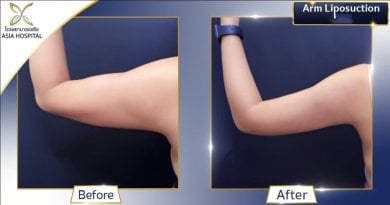 Before and after Vaser arm liposuction results at Asia Cosmetic Hospital, slimmer arm contour