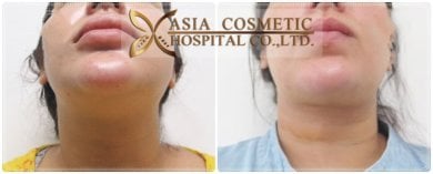 Before and after Vaser liposuction results at Asia Cosmetic Hospital, chin and neck contouring