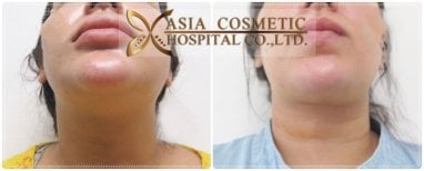 Before and after Vaser liposuction results at Asia Cosmetic Hospital, chin and neck contouring