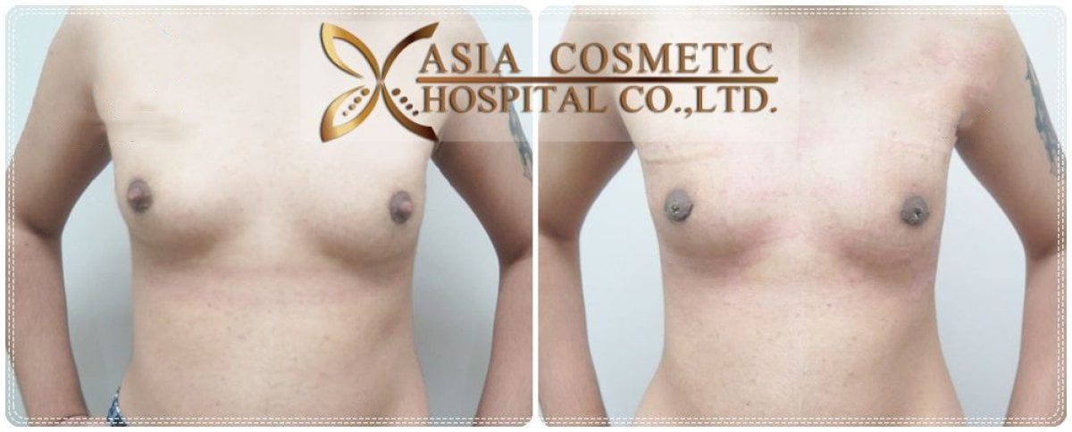 Vorher-nachher-Ergebnis der Top-OP bei Asia Cosmetic Hospital, maskuliner Brustbereich