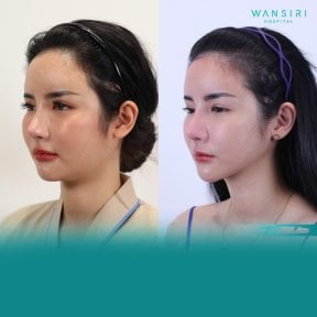 Before and after rhinoplasty at Wansiri Hospital, nose reshaping with natural-looking result