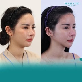 Before and after Vaser liposuction face contouring results at Wansiri Hospital
