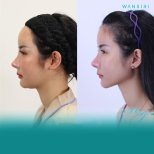 Before and after rhinoplasty at Wansiri Hospital, nose reshaping with natural-looking results