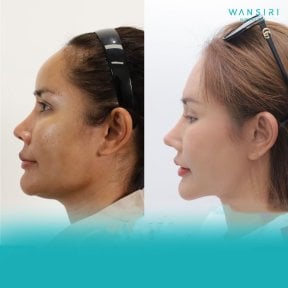Before and after Vaser liposuction at Wansiri Hospital, improved jawline contour result