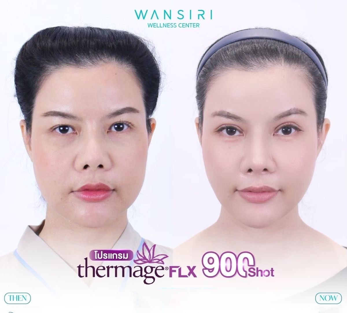 Resultados antes y después de Thermage FLX en Wansiri Hospital – mejora de la piel facial